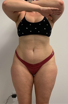Buttock Lift with Augmentation Before Photo by Johnny Franco, MD; ,  - Case 45462