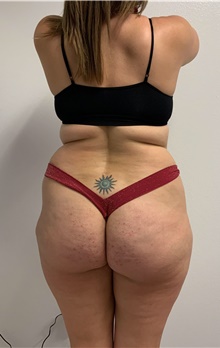 Buttock Lift with Augmentation Before Photo by Johnny Franco, MD; ,  - Case 45462
