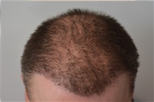 Hair Transplant After Photo by Ellen Janetzke, MD; ,  - Case 45625