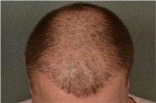 Hair Transplant Before Photo by Ellen Janetzke, MD; ,  - Case 45625