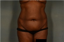 Tummy Tuck Before Photo by Ellen Janetzke, MD; ,  - Case 45633