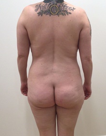 Buttock Lift with Augmentation Before Photo by Johnny Franco, MD; ,  - Case 45667