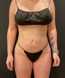 Buttock Lift with Augmentation After Photo by Johnny Franco, MD; ,  - Case 45841