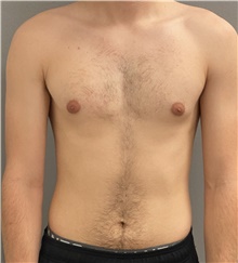 Male Breast Reduction Before Photo by Keshav Magge, MD; Bethesda, MD - Case 45988