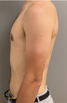 Male Breast Reduction After Photo by Keshav Magge, MD; Bethesda, MD - Case 45988