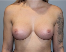 Breast Augmentation After Photo by Ellen Mahony, MD; Westport, CT - Case 46040