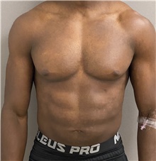 Male Breast Reduction Before Photo by Keshav Magge, MD; Bethesda, MD - Case 46227