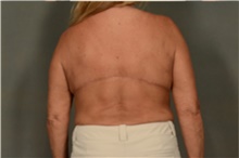 Body Lift After Photo by Ellen Janetzke, MD; ,  - Case 46271