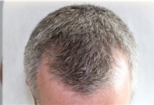 Hair Transplant After Photo by Ellen Mahony, MD; Westport, CT - Case 46283