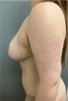 Mommy Makeover After Photo by Franklin Richards, MD; ,  - Case 46300