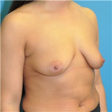 Breast Augmentation Before Photo by Joshua Cooper, MD; Seattle, WA - Case 46529