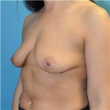 Breast Augmentation Before Photo by Joshua Cooper, MD; Seattle, WA - Case 46529