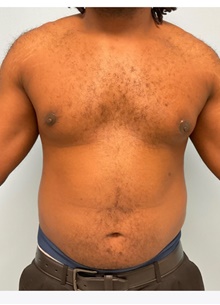 Liposuction After Photo by Julia Spears, MD, FACS; ,  - Case 46546