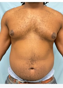 Liposuction Before Photo by Julia Spears, MD, FACS; ,  - Case 46546