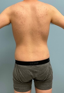 Liposuction After Photo by Julia Spears, MD, FACS; ,  - Case 46548