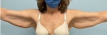 Arm Lift Before Photo by Julia Spears, MD, FACS; ,  - Case 46632