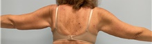 Arm Lift After Photo by Julia Spears, MD, FACS; ,  - Case 46632