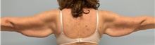 Arm Lift Before Photo by Julia Spears, MD, FACS; ,  - Case 46632