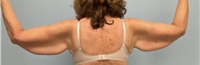 Arm Lift Before Photo by Julia Spears, MD, FACS; ,  - Case 46632