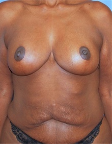Breast Lift After Photo by Siamak Agha, MD PhD FACS; ,  - Case 46688