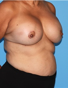 Breast Lift After Photo by Siamak Agha, MD PhD FACS; ,  - Case 46708