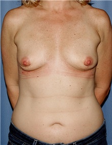 Breast Augmentation Before Photo by Siamak Agha, MD PhD FACS; ,  - Case 46747