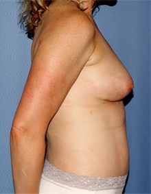 Breast Augmentation After Photo by Siamak Agha, MD PhD FACS; ,  - Case 46747
