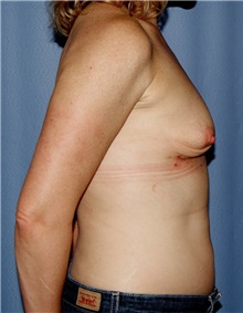 Breast Augmentation Before Photo by Siamak Agha, MD PhD FACS; ,  - Case 46747