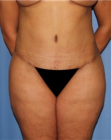 Tummy Tuck After Photo by Siamak Agha, MD PhD FACS; ,  - Case 46774