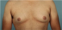 Male Breast Reduction Before Photo by Keyian Paydar, MD, FACS; Newport Beach, CA - Case 46868