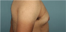 Male Breast Reduction Before Photo by Keyian Paydar, MD, FACS; Newport Beach, CA - Case 46868