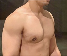 Male Breast Reduction After Photo by Keyian Paydar, MD, FACS; Newport Beach, CA - Case 46877