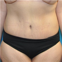 Body Lift After Photo by Joshua Cooper, MD; Seattle, WA - Case 47206