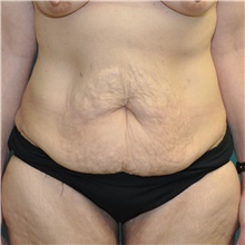 Body Lift Before Photo by Joshua Cooper, MD; Seattle, WA - Case 47206