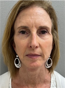 Facelift After Photo by Franklin Richards, MD; ,  - Case 47485