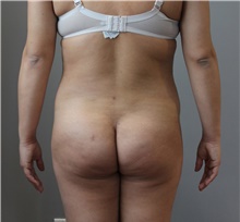 Liposuction After Photo by Ellen Mahony, MD; Westport, CT - Case 47496