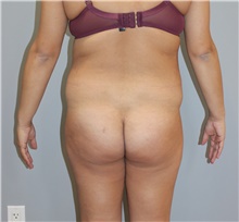 Liposuction Before Photo by Ellen Mahony, MD; Westport, CT - Case 47496