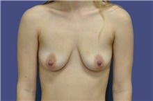 Breast Augmentation Before Photo by Lisa Jewell, MD, FACS; Torrance, CA - Case 47501
