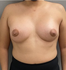 Breast Augmentation After Photo by Keshav Magge, MD; Bethesda, MD - Case 47595