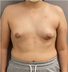 Breast Augmentation Before Photo by Keshav Magge, MD; Bethesda, MD - Case 47595