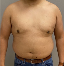 Male Breast Reduction After Photo by Keshav Magge, MD; Bethesda, MD - Case 47598
