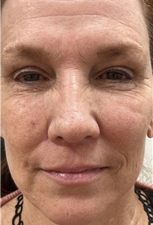 Lip Augmentation/Enhancement After Photo by Franklin Richards, MD; ,  - Case 47634
