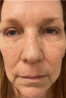 Lip Augmentation/Enhancement Before Photo by Franklin Richards, MD; ,  - Case 47634
