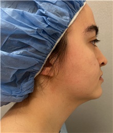 Liposuction Before Photo by Franklin Richards, MD; ,  - Case 47635