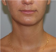 Liposuction After Photo by Ellen Mahony, MD; Westport, CT - Case 47754
