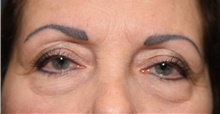 Eyelid Surgery Before Photo by Derek Cody, MD, FACS; ,  - Case 47811