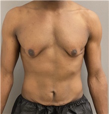 Male Breast Reduction Before Photo by Keshav Magge, MD; Bethesda, MD - Case 48018