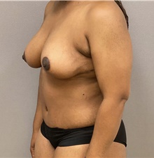 Tummy Tuck After Photo by Keshav Magge, MD; Bethesda, MD - Case 48128