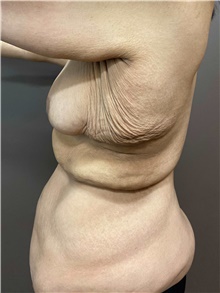 Body Contouring Before Photo by Owen Reid, MD; Richmond, BC - Case 48201