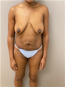 Mommy Makeover Before Photo by Keshav Magge, MD; Bethesda, MD - Case 48216